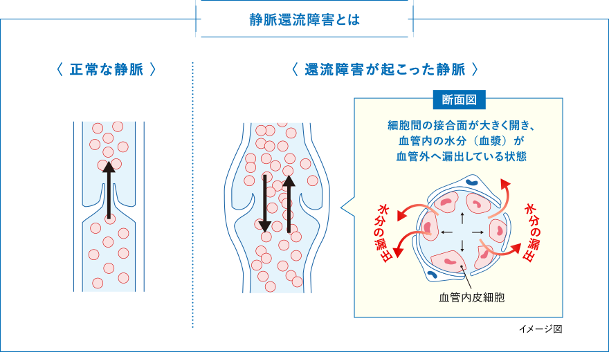 静脈還流障害